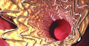 arterelor