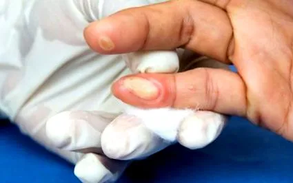 причини ксантоми