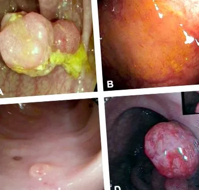 polipilor Medical Review