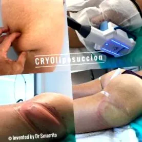 cryoliposuction