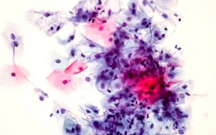 Candida Albicans