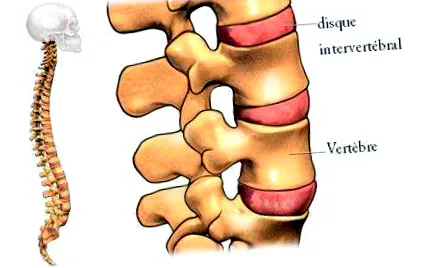 herniated