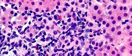 hepatitis autoimmun