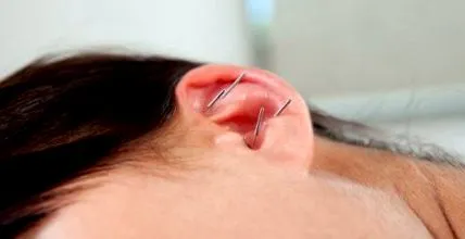 Acupunctura auriculară