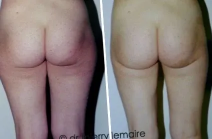 Liposucție Liposucția