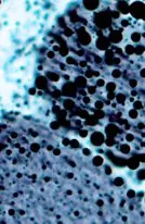 miopatia