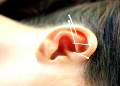 acupunctura slăbi