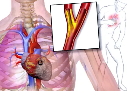 angina