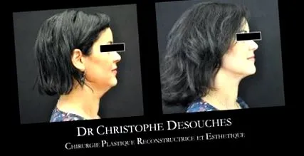 vibroliposuction marseille