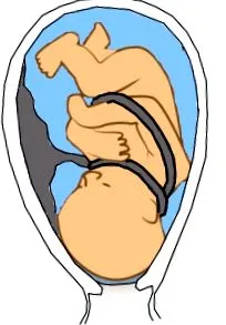 cordonul este leziuni