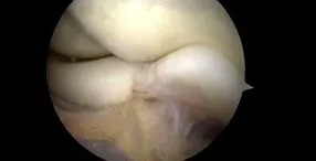 artroscopia