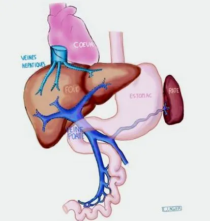 cirrhosis