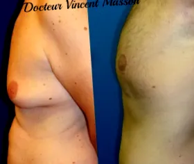 estetică ginecomastie