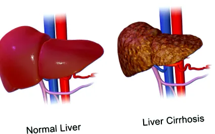 cirrhosis