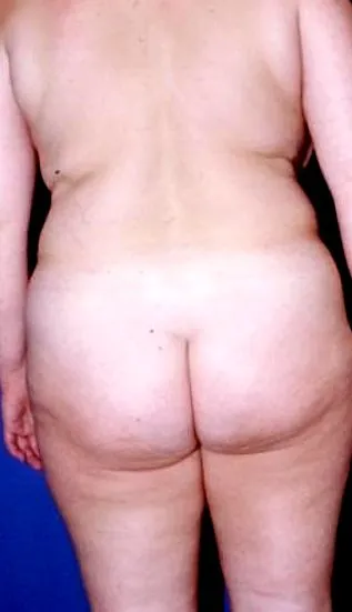liposucție