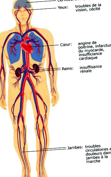 hipertensiune