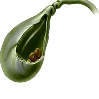 lithiasis