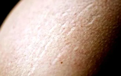 vergeturile