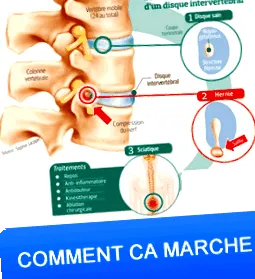 intervertebrale