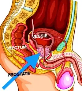 adenoma