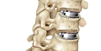 cervical
