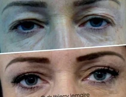 blefaroplastia superioară