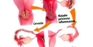 chlamydia megelőzése