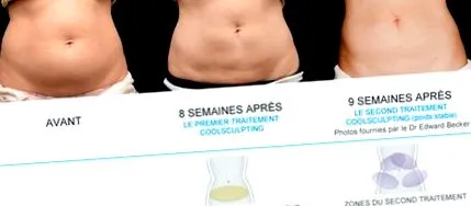 coolsculpting