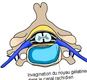 disc herniate