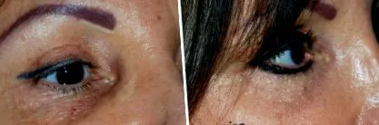 lipofilling