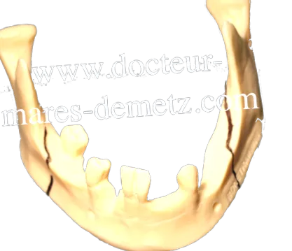 metz mares