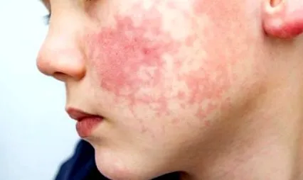 dermatitis