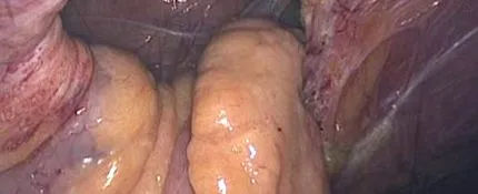 hernie peretelui