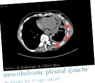 mesothelioma