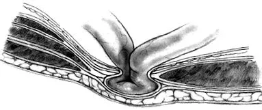 hernii