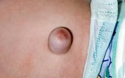 hernia