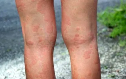 planeta urticaria