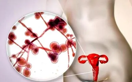 vaginosis