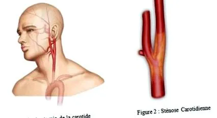 stenosis carotis