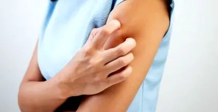 urticaria kell