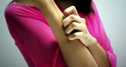 urticaria