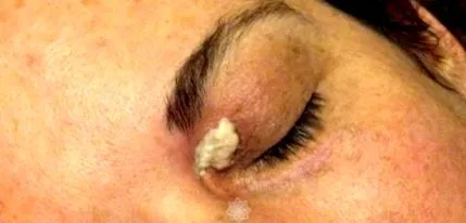 hogy xanthelasma