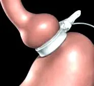 hipnoza