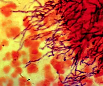 actinomycosis