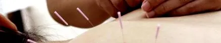 acupunctura