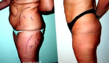 abdominală