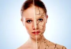 psoriasis