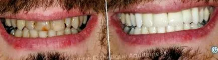implanturile