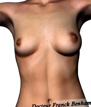 asym kezelése
