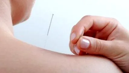 acupunctura